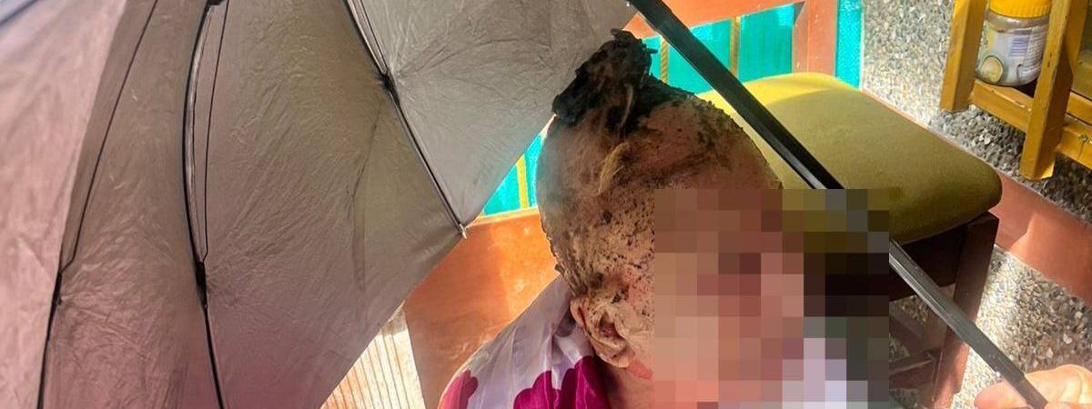 La mujer sufrió quemaduras graves. FOTO: Frecuencia Estéreo 88.4