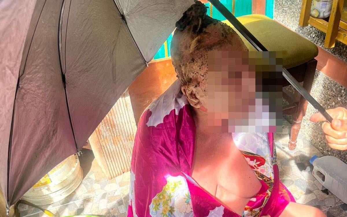 La mujer sufrió quemaduras graves. FOTO: <a rel=nofollow href=https://www.facebook.com/frecuenciaestereo88.4?__cft__[0]=AZZKb4fBoFzjDAYHpYqwP2juoYSpTvHU_qn5GXuqBO6HEPXlT7GNKWTpba5-7uHQ-yQKqZU4moyRv74Ji_3g3b2si2rqArqlPPA_IQyxlRgHgxNXAiXoYeEzQ1Iq8F6nsSi5Ajv-mPF-cf034C9OJOe84id2NK6g0L3C6LkOpoYdRcfopMDAOWgdD7E-soEUhWA&amp;__tn__=-UC*F>Frecuencia Estéreo 88.4</a>