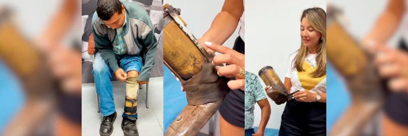 Así era la prótesis que utilizaba Luis antes. /FOTOS: CAPTURAS DE PANTALLA. 