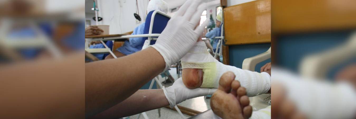 Quemados por pólvora. FOTO: DONALDO ZULUAGA