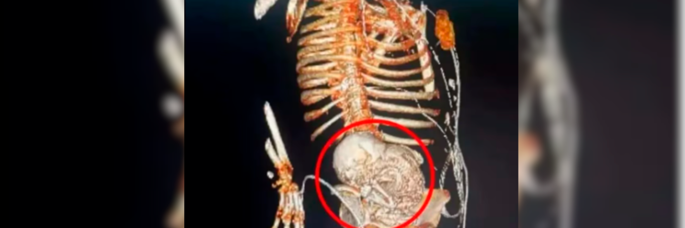 Así se veía el feto calcificado en la tomografía. /FOTO: REDES SOCIALES 