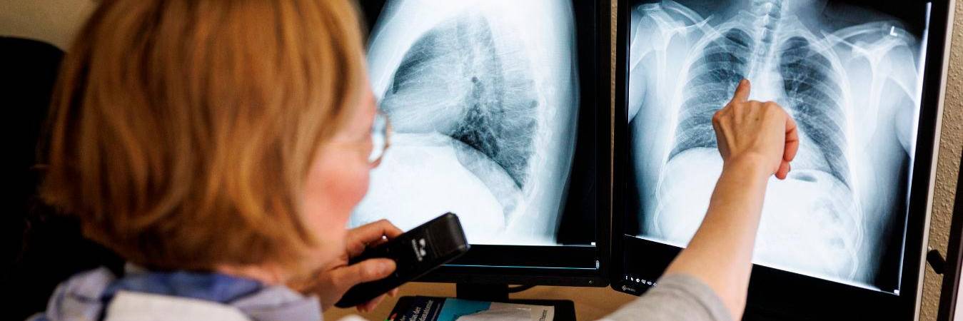 La tuberculosis es una enfermedad infecciosa causada por una bacteria y afecta a los pulmones. /FOTO: GETTY