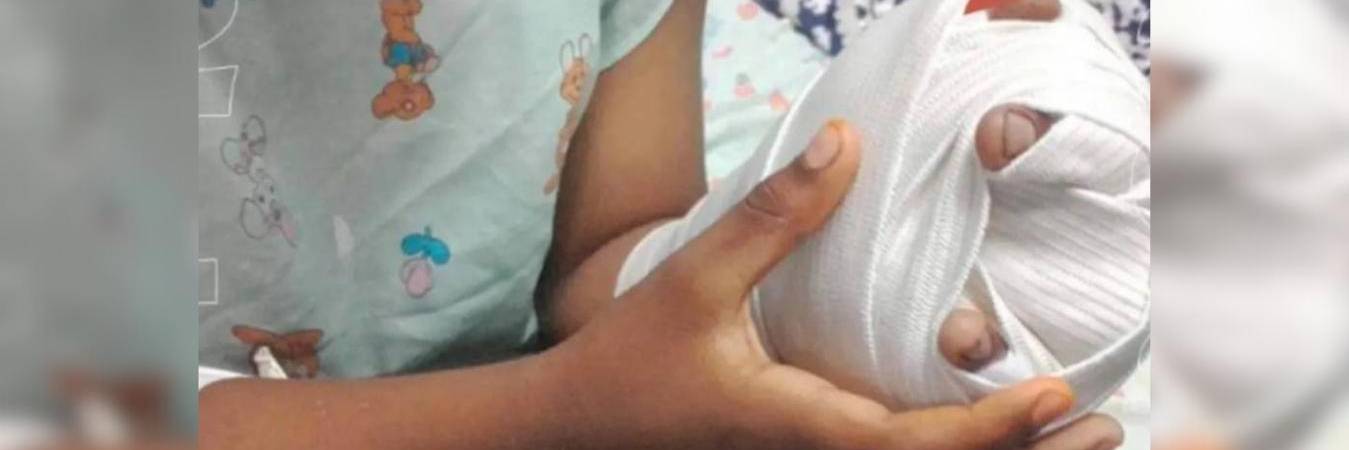 Niño quemado con pólvora. FOTO: COLPRENSA 