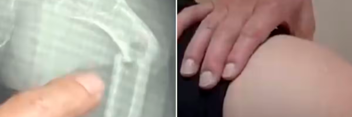 Ye se fracturó el hueso más fuerte del cuerpo humano. / FOTO: COLPRENSA - VANGUARDIA