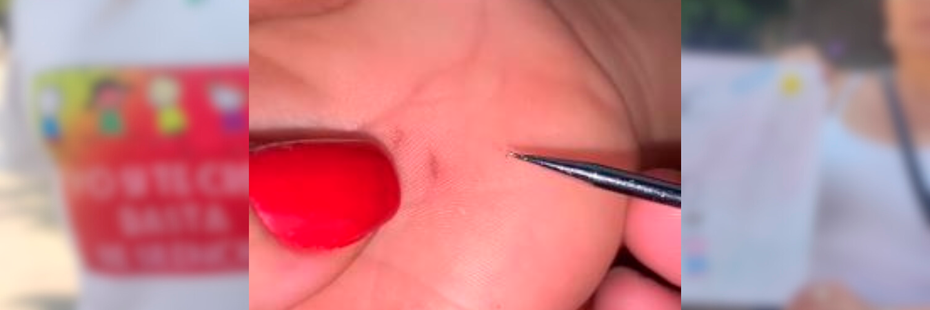 Así quedó la mano del niño tras la agresión. /FOTO: CAPTURA DE VIDEO