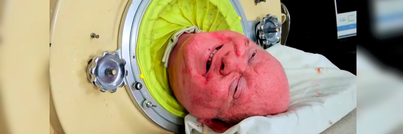 Paul Alexander pasó 70 años dentro de una máquina que lo ayudaba a respirar. / FOTO: CAMPAÑA GOFUNDME
