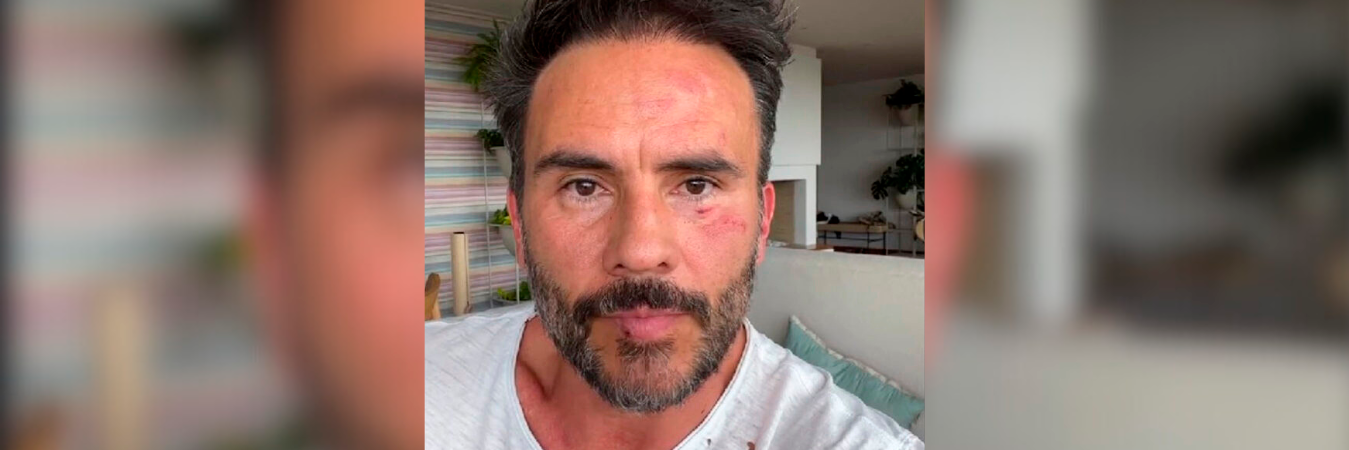 Así quedó Juan Pablo Raba tras el robo. /FOTOCAPTURA DE INSTAGRAM