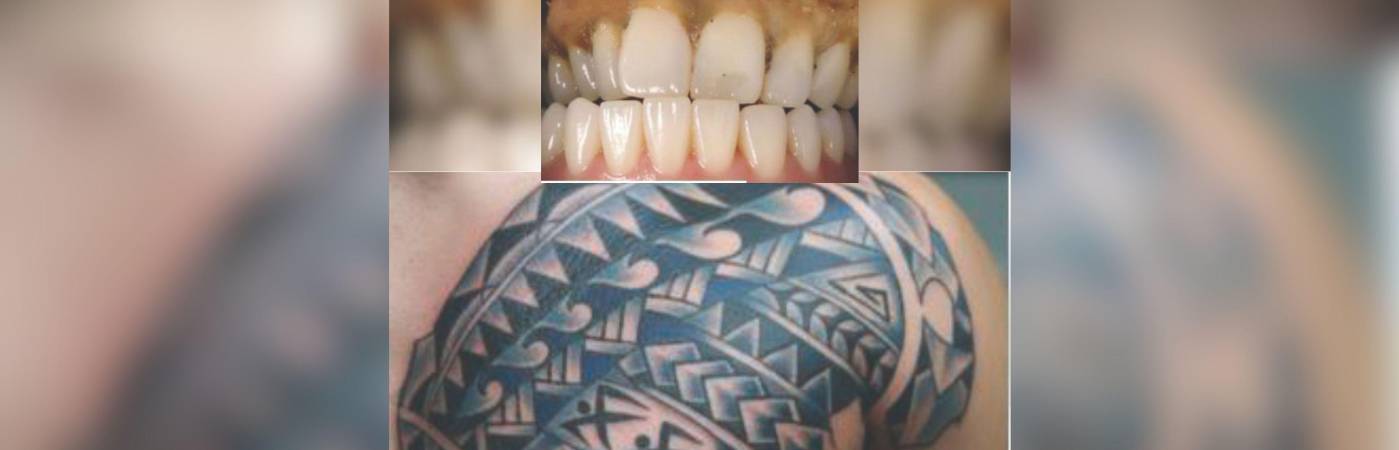 La dentadura y el tatuaje del hombre fallecido que permanece en Medicina Legal sin ser identificado. FOTOS: CORTESÍA MEDICINA LEGAL