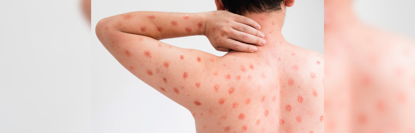 Esta enfermedad antes era conocida como la viruela símica o viruela del mono. / FOTO: CANVA - PARA ILUSTRAR