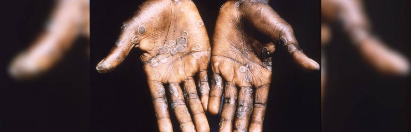 La enfermedad fue descubierta en monos en 1958. FOTO: GETTY