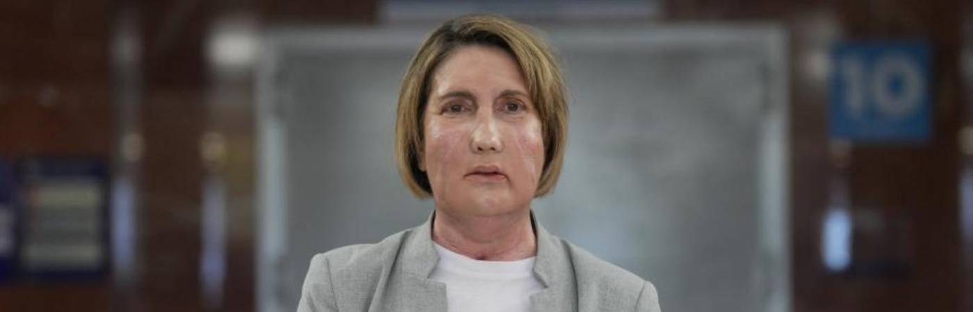 Mujer que recibió el primer trasplante parcial de cara de persona con donante de eutanasia. FOTO: MEDUZA 