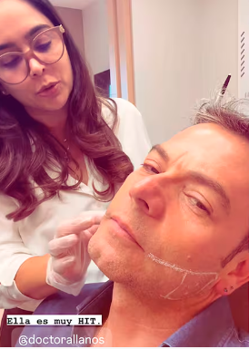 Así quedó Iván Lalinde tras inyectarse bótox: mostró proceso