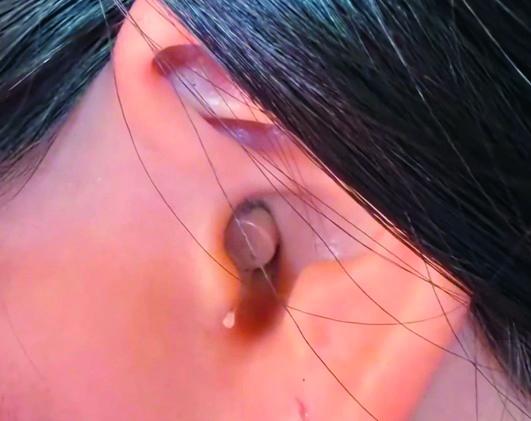 Este fue uno de los dispositivos auditivos que usaron los profesionales durante la prueba. FOTO: CORTESÍA