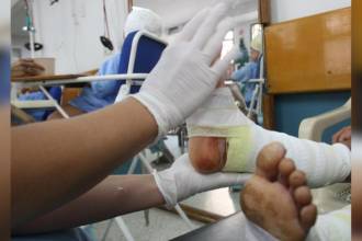 Quemados por pólvora. FOTO: DONALDO ZULUAGA