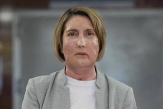 Mujer que recibió el primer trasplante parcial de cara de persona con donante de eutanasia. FOTO: MEDUZA 