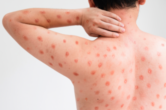 Esta enfermedad antes era conocida como la viruela símica o viruela del mono. / FOTO: CANVA - PARA ILUSTRAR