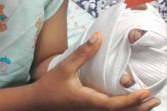 Niño quemado con pólvora. FOTO: COLPRENSA 