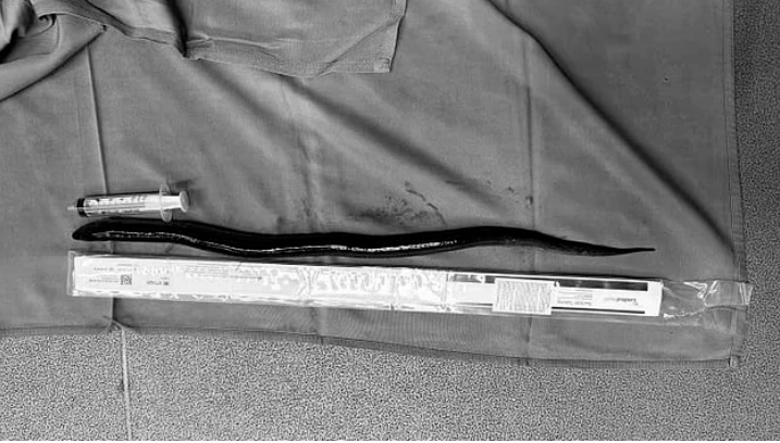 La anguila retirada del estómago del hombre tenía 30 centímetros de longitud. /FOTO: REDES SOCIALES 