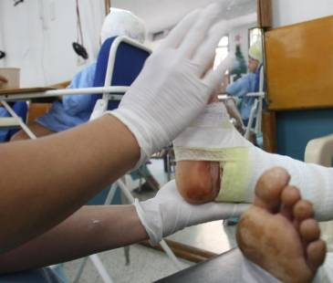 Quemados por pólvora. FOTO: DONALDO ZULUAGA