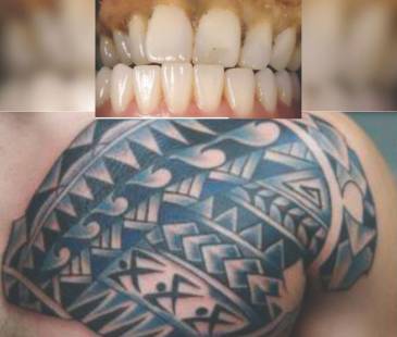 La dentadura y el tatuaje del hombre fallecido que permanece en Medicina Legal sin ser identificado. FOTOS: CORTESÍA MEDICINA LEGAL