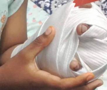 Niño quemado con pólvora. FOTO: COLPRENSA 