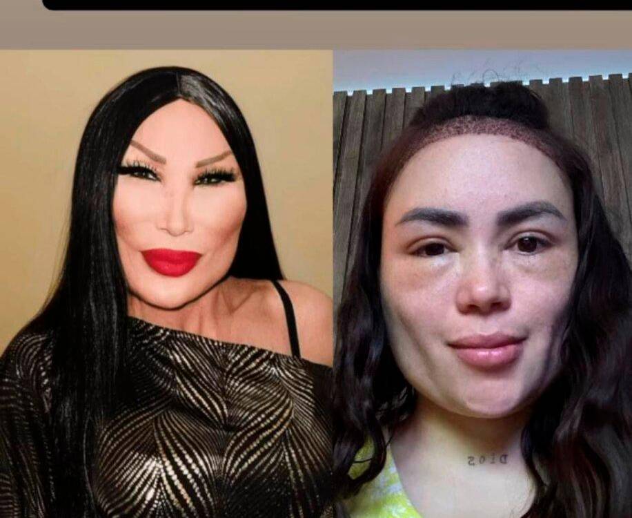 $!¿Es otra? Así luce Epa Colombia tras someterse a un trasplante capilar