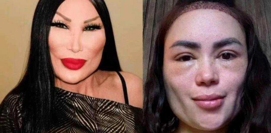 ¿Es otra? Así luce Epa Colombia tras someterse a un trasplante capilar