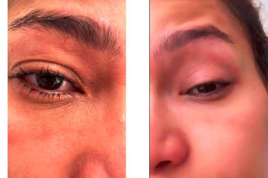 $!La modelo dijo que tenía rojo el ojo y que veía un poco borroso. /FOTO: CAPTURA DE PANTALLA